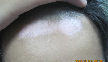 白癜风的白斑刚刚发病都是多大的