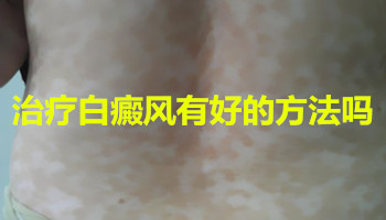 治疗白癜风有好的方法吗