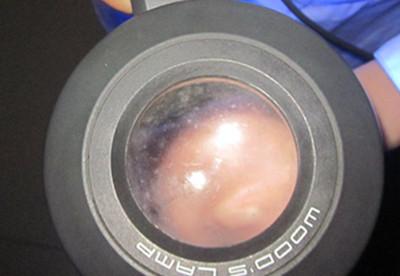 伍德灯照射诊断白癜风对皮肤有伤害吗