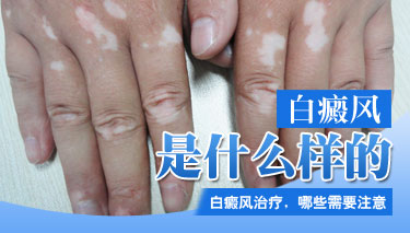 手部有白癜风受伤之后会扩散吗