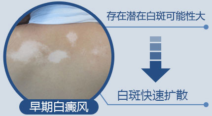白癜风扩散之后还能自己恢复吗
