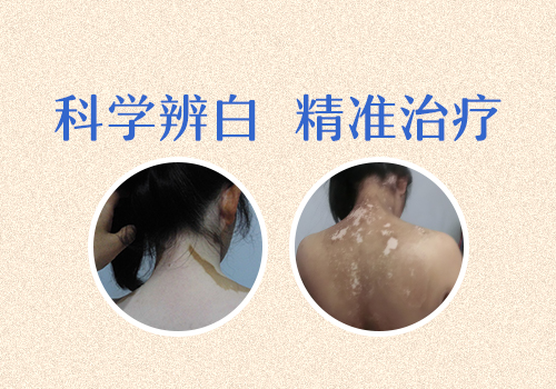 白癜风现在治疗也不晚