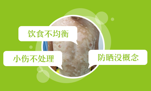 补铜对于白癜风有什么影响吗