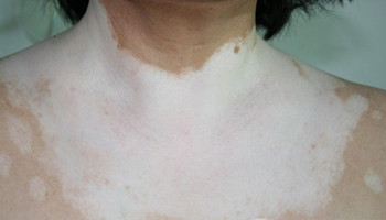 白癜风的白斑使劲用手搓会变红吗