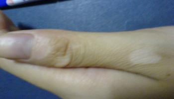 手指关节白癜风的治疗