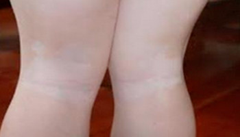 腿上出现的小块白斑是白癜风吗