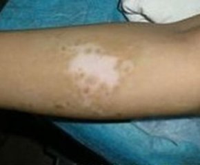 小面积白癜风怎么快速治好