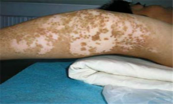 目前什么方法治大面积白癜风比较管用