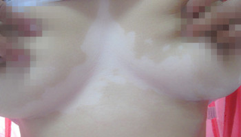 皮肤局部白斑会不会扩散