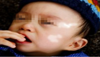 衡水白癜风医院哪家治疗儿童白癜风好