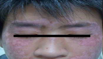 脸上长白癜风可以做黑色素种植吗