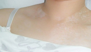 白癜风早期的症状你是不是都了解