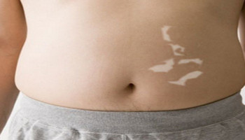 肚子白癜风的治疗