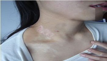 脖子上一块块白怎么回事