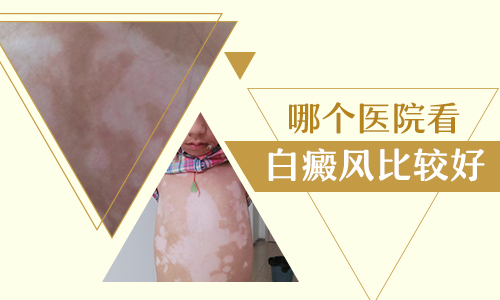  邢台治疗白癜风技术怎么样