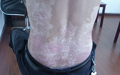  后背的白斑做植皮手术多久能恢复
