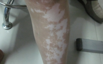 腿部白癜风发红变疼怎么回事