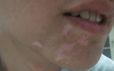 孩子长身体时期发现嘴角长了很多白斑是怎么回事