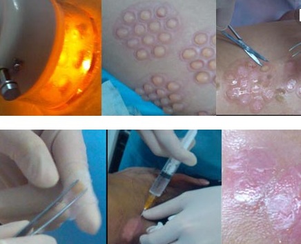 白癜风黑色素培植效果如何