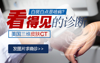 白癜风吃什么药控制不扩散效果好