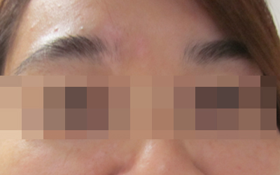 怎样控制住发展期白癜风