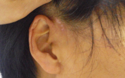 耳后有片白斑怎么检查是不是白癜风