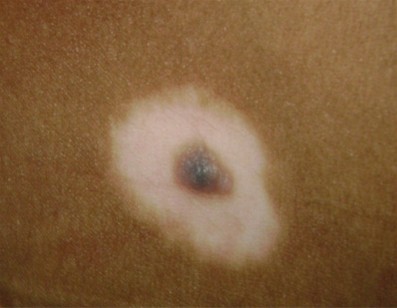 晕痣是什么，有晕痣会发展成白癜风吗?