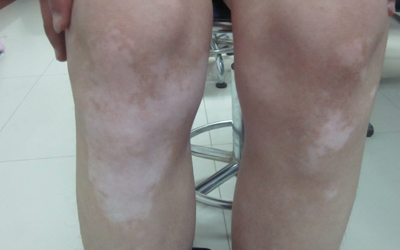  散发型白癜风怎么治有明显效果