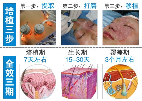 白癜风种植黑色素后多久能长好