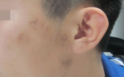 近期在脸颊左侧发现一块白斑是不是白癜风
