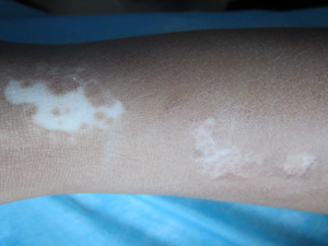 宝宝腿部白癜风的图片