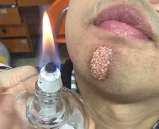 火针治疗白斑恢复过程是什么样