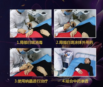 纳晶配合药物治白癜风的效果怎么样 