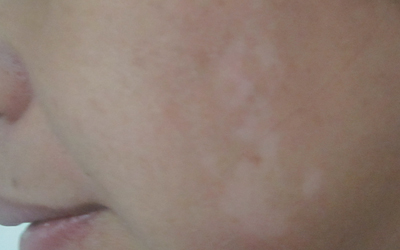孩子脸上有块白是白癜风早期症状吗