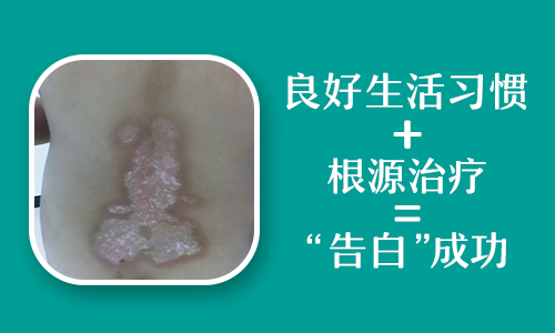 有没有保证白癜风永久不扩散的良方