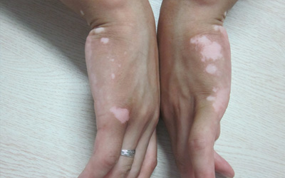 小孩手指有白点是什么原因