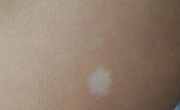 5个月宝宝后背有白斑用什么方法能治好