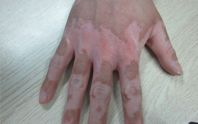 手部白癜风用补骨脂泡酒扩散更严重怎么办