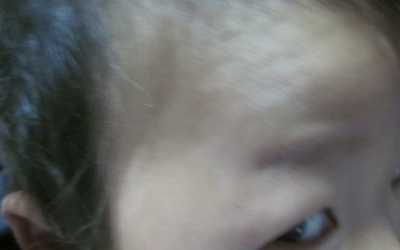 面部白癜风恢复展示图