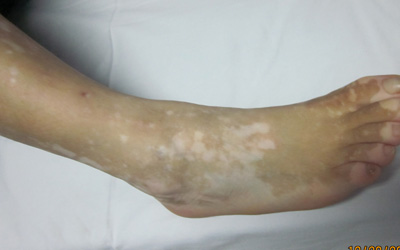 脚底有白色硬白点图片