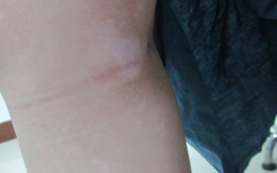 孩子胳膊起白斑