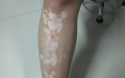 女性胳膊腿上长白块2年多了该怎么治