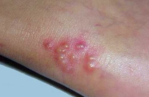 白癜风照激光有什么不良反应