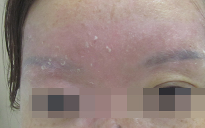 眉毛处长白癜风可以做韩式半永久吗