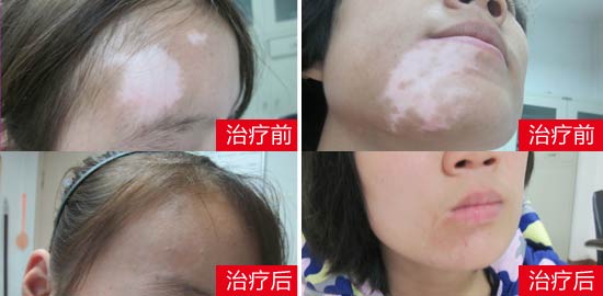 脸部白斑照308激光