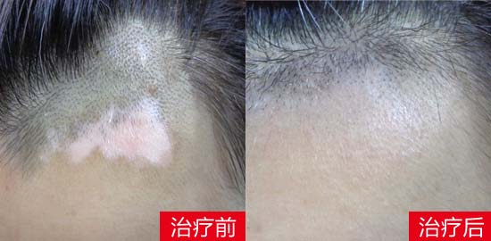 儿童白癜风症状图治疗前后对比图