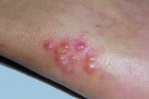 身上白癜风照311后起水泡能戳破吗