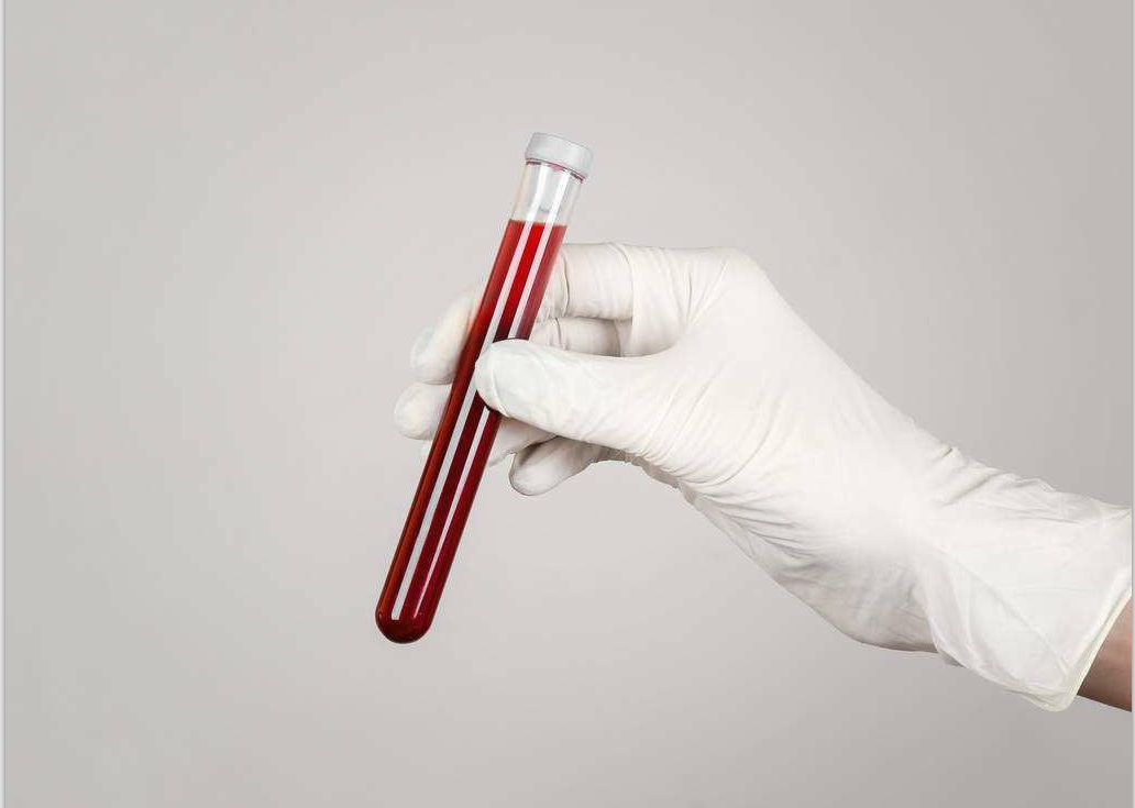 白癜风治疗前需要抽血化验吗