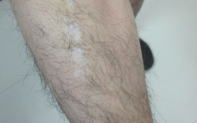 小白斑面积明显变大该怎么治