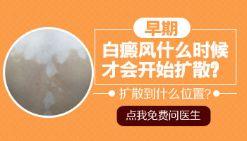 白癜风一般是出现多久会扩散
